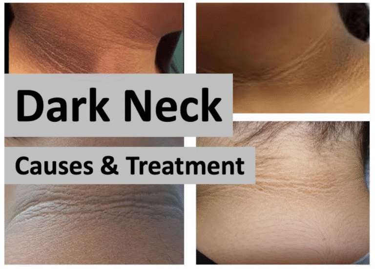 Home Remedies For Dark Neck